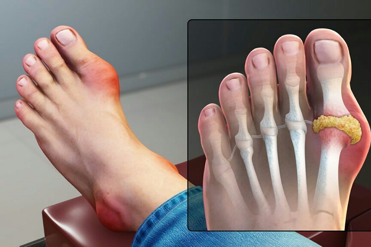 Surge in gout cases during the pandemic