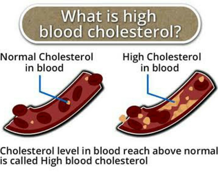 High blood cholesterol 
