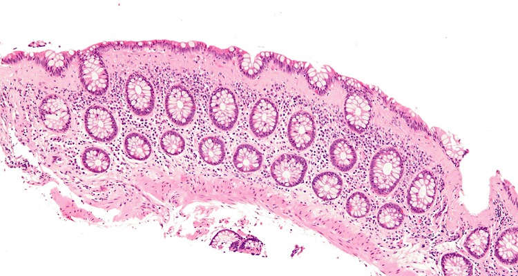 Microscopic colitis
